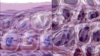 Progression of Conjunctival Intraepithelial Neoplasia [upl. by Nonnair]