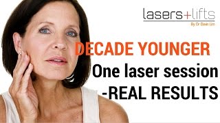 Laser resurfacing  one decade younger [upl. by Asserac]