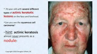 Dermatology wk5Win21 Actinic Keratosis [upl. by Walrath921]