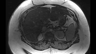 Hepatic Steatosis [upl. by Nirrol]