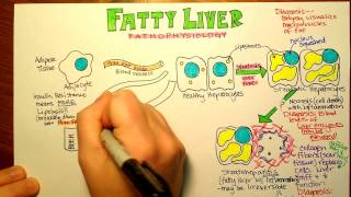 Fatty Liver Pathophysiology [upl. by Htenywg]