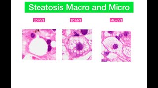 Macro and microvesicular steatosis in liver [upl. by Hulbert]