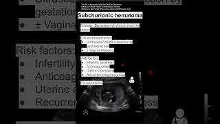 Subchorionic hematoma [upl. by Aslin]