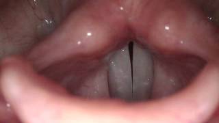 Stroboscopy Normal Female Vocal Cords [upl. by Yrailih]