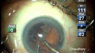 Micro incision cataract surgery MICS by phaco at Eye7 Delhi India [upl. by Katie]