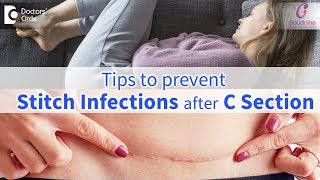 CSection Stitch InfectionsSigns Prevention amp Treatment  Immediate CareDrShashikala Hande of C9 [upl. by Refanej]