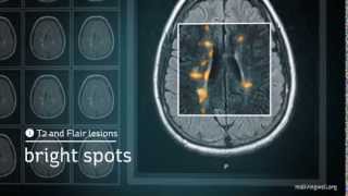 Multiple Sclerosis Understanding Your MRI [upl. by Larentia110]