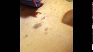 Treatment of Seborrheic Keratosis [upl. by Bella]