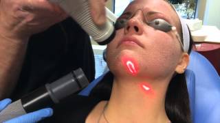 Recovery After CO2 Laser Facial [upl. by Noteek]