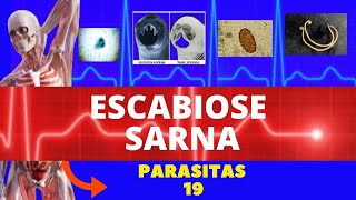 ESCABIOSE  SARNA HUMANA SARCOPTES SCABIEI HOMINIS  PARASITOLOGIA  INFECTOLOGIA [upl. by Tocs]