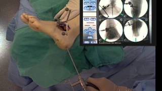 Ankle Surgery Subtalar Arthrodesis [upl. by Andrel127]