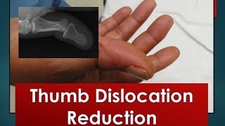 Thumb Dislocation Reduction [upl. by Kostman308]