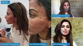 CO2 Laser Resurfacing treatment at London Laser Clinic [upl. by Assirialc145]