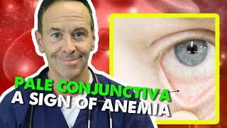 Pale Conjunctiva  A Sign of Anemia [upl. by Niwri]