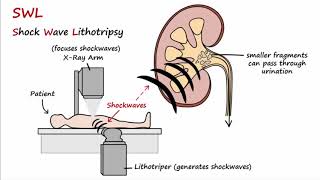 Kidney Stones  Types Formation Treatment Prevention [upl. by Xonel]