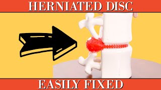 Herniated Disc Clearly Explained amp Easily Fixed [upl. by Humfrid]