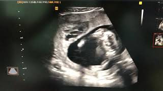 Subchorionic and retroplacental hematoma ultrasound sonography [upl. by Nnewg773]