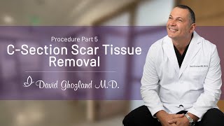 CSection Scar Tissue Removal  Procedure Part 5  David Ghozland MD [upl. by Dominga]