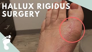 Hallux Rigidus Surgery [upl. by Tehr]