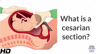 What is a Cesarian Section [upl. by Ellener]