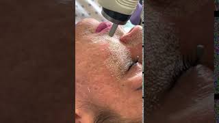 Fractional CO2 Laser Resurfacing [upl. by Kedezihclem]