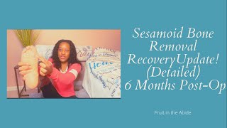 Sesamoid Bone Removal Recovery Update 6 Months PostOp  detailed [upl. by Parrisch481]