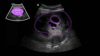 POCUS 1st Trimester Pregnancy Case 3  Twin Gestation 6w5d [upl. by Joyce224]