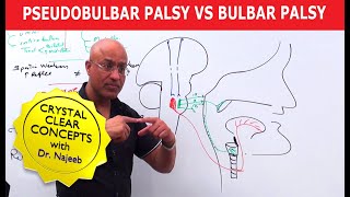 Pseudobulbar Palsy vs Bulbar Palsy [upl. by Marybella]