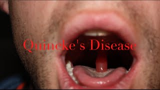 quinckes disease  medical minute [upl. by Robby140]