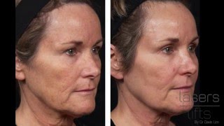 How long does it take to heal from CO2 laser resurfacing Fractional [upl. by Annahael]