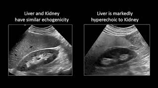 GI Imaging  Hepatic Steatosis and Cirrhosis [upl. by Enneicul320]