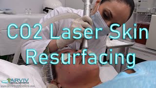 Fractionated CO2 Laser Skin Resurfacing by ArvivAestheticscom [upl. by Hartman]