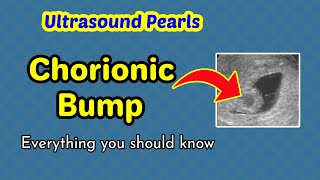 Ultrasound Pearls Chorionic Bump [upl. by Darrey]