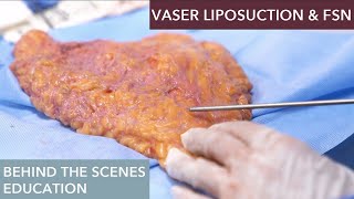 The Science Behind Vaser Liposuction How Does It Work [upl. by Llezom972]