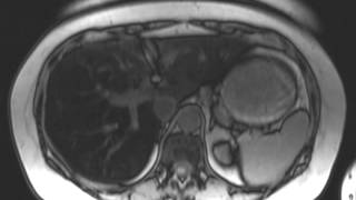 Hepatic Steatosis [upl. by Ainatnas]