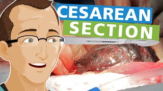 Cesarean Section [upl. by Nola]