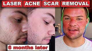 Acne Scar Removal Before And After 6 Months Fractional C02 Laser Skin Resurfacing [upl. by Brebner921]