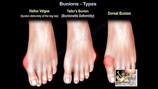 Bunions Types  Everything You Need To Know  Dr Nabil Ebraheim [upl. by Betthezel892]