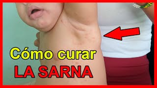 Brote de SARNA en Cuba 😖 Cómo tratar y CURAR la piel SIN MEDICINAS ✅ [upl. by Marika]