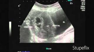 Ultrasound video of subchorionic hematoma early pregnancy [upl. by Burl250]