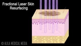 Traditional versus Fractional Laser Skin Resurfacing Procedure Animation [upl. by Enicnarf474]