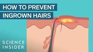 What Are Ingrown Hairs — And How To Treat Them [upl. by Heyward765]