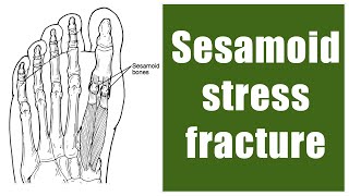 Sesamoid stress fracture surgery in runners [upl. by Cari281]