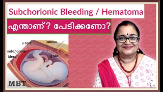 Subchorionic HematomaBleeding In Pregnancy What Is It Should You Be Afraidഎന്താണ്പേടിക്കണോMBT [upl. by Lienet]