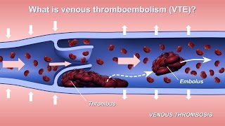 Endovenous Laser Ablation EVLA treatment of varicose veins [upl. by Albina]