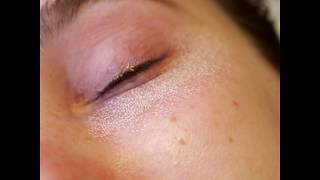 Co2 Laser Skin Resurfacing Under The Eyes  Kami Parsa MD Beverly Hills Oculoplastic Surgeon [upl. by Dearr]