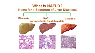 Fatty Liver Disease amp NASH Nonalcoholic Steatohepatitis  Causes Symptoms Diagnosis amp Treatment [upl. by Jenni]