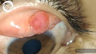 palpebral conjunctival pyogenic granuloma CC91 [upl. by Mutua]