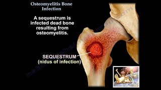 Osteomyelitis Bone Infection  Everything You Need To Know  Dr Nabil Ebraheim [upl. by Enelrac]