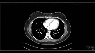 My Treatment Approach to Multiple System Atrophy [upl. by Lodi466]